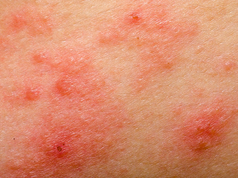 photo eczema